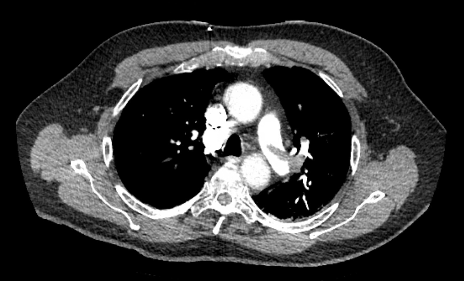 CT angiogram showing bilateral acute pulmonary thromboemboli.
