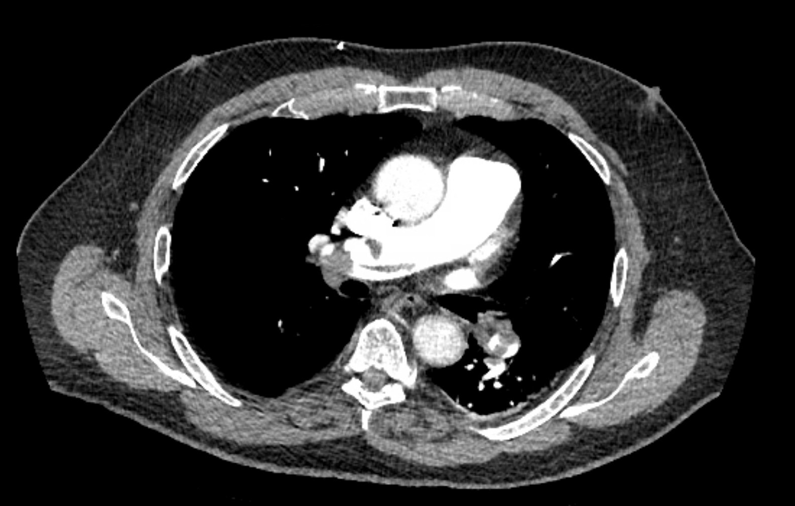 CT angiogram showing bilateral acute pulmonary thromboemboli.