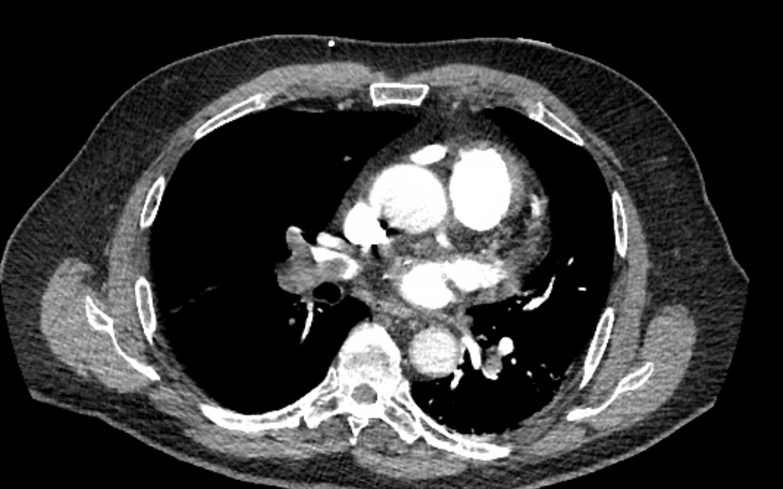 CT angiogram showing bilateral acute pulmonary thromboemboli.