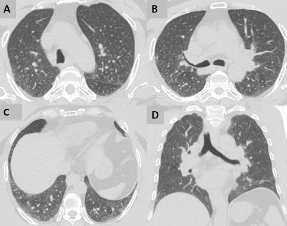 Noncontrast-enhanced chest CT scans lung windows (A-C, axial views; D, coronal view).