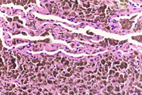 Lung biopsy specimen. Hematoxylin-eosin stain (×100 magnification).