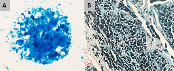 Prussian blue stain. A, Alveolar lavage fluid (×1,000 magnification). B, Cryobiopsy specimen (×100 magnification).