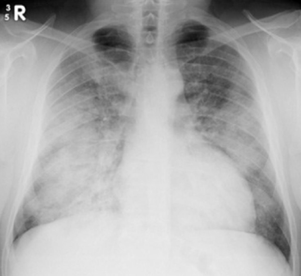 Figure 2. Chest radiograph