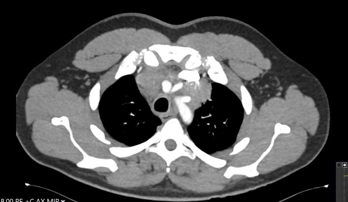 Figure 1: CT image showing large mediastinal mass found to be thymic carcinoma.