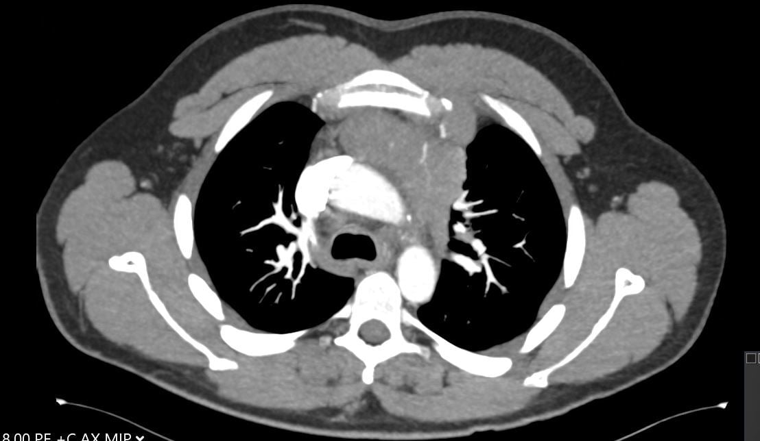 Figure 2: CT image showing large mediastinal mass found to be thymic carcinoma.