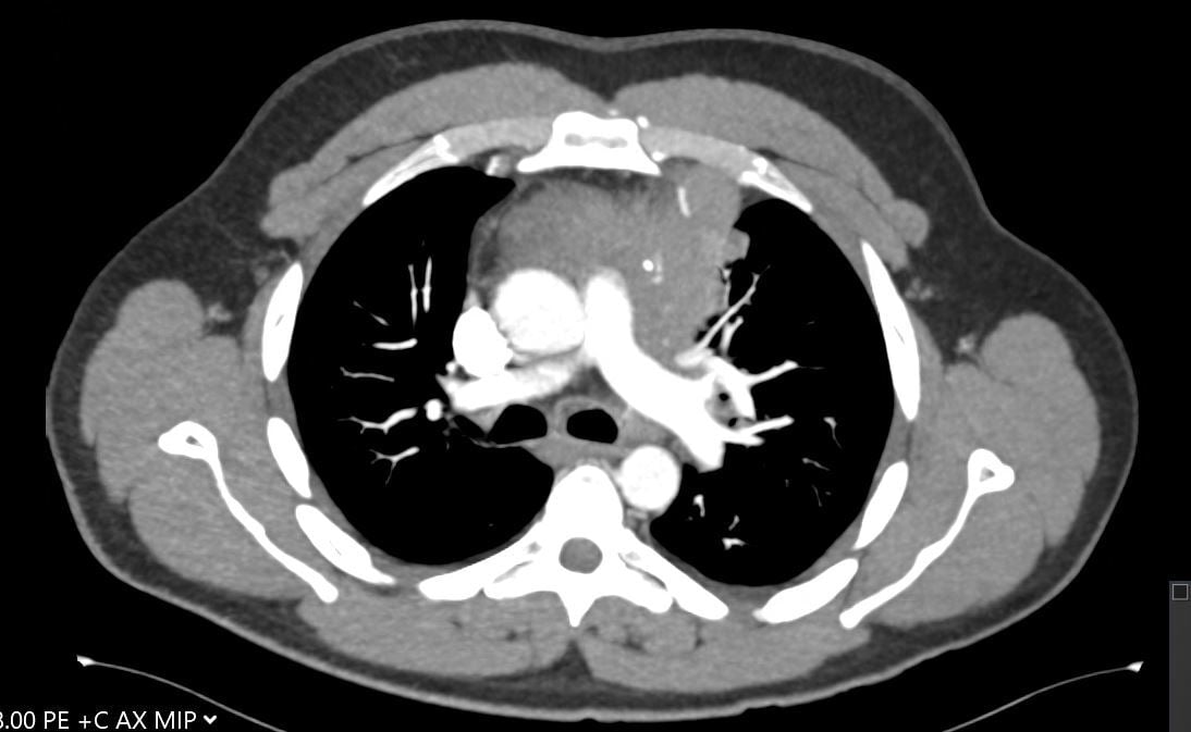Figure 3: CT image showing large mediastinal mass found to be thymic carcinoma.