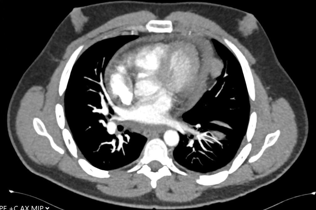 Figure 4: CT image showing small pericardial effusion.
