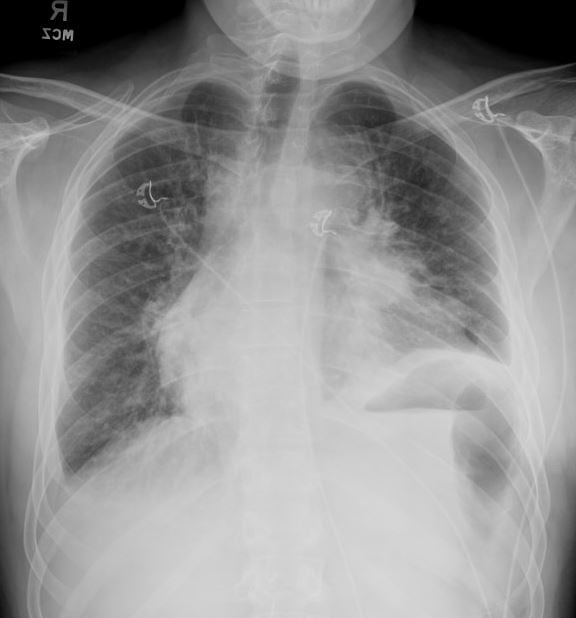 Figure 5: Chest radiograph prior to pericardiocentesis.