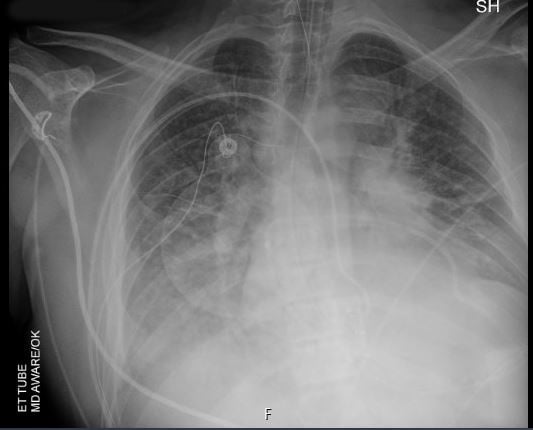 Figure 6: Chest radiograph following pericardiocentesis and endotracheal intubation.